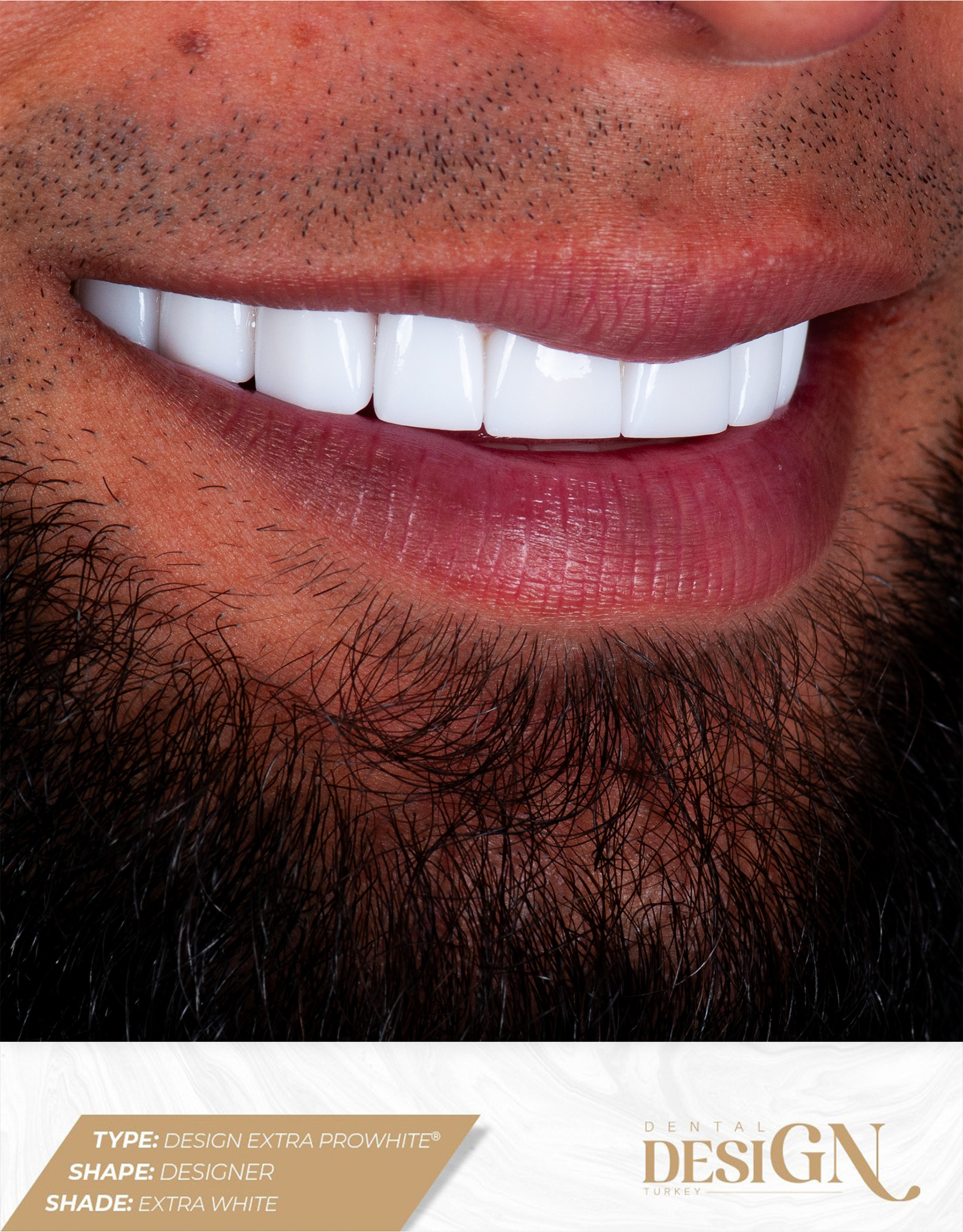 DESIGN EXTRA PROWHITE® – Zirconium Porcelain Crown