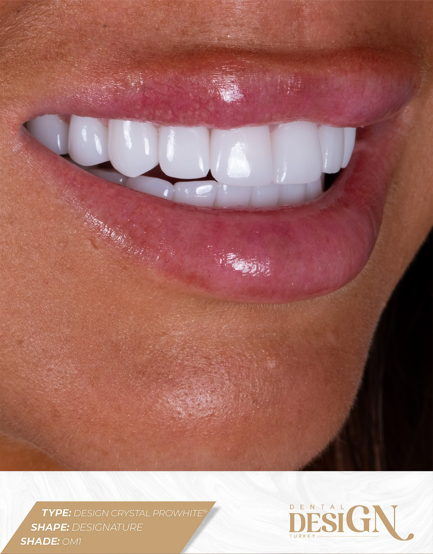 DESIGN CRYSTAL PROWHITE® – Monolithic Zirconium Crown