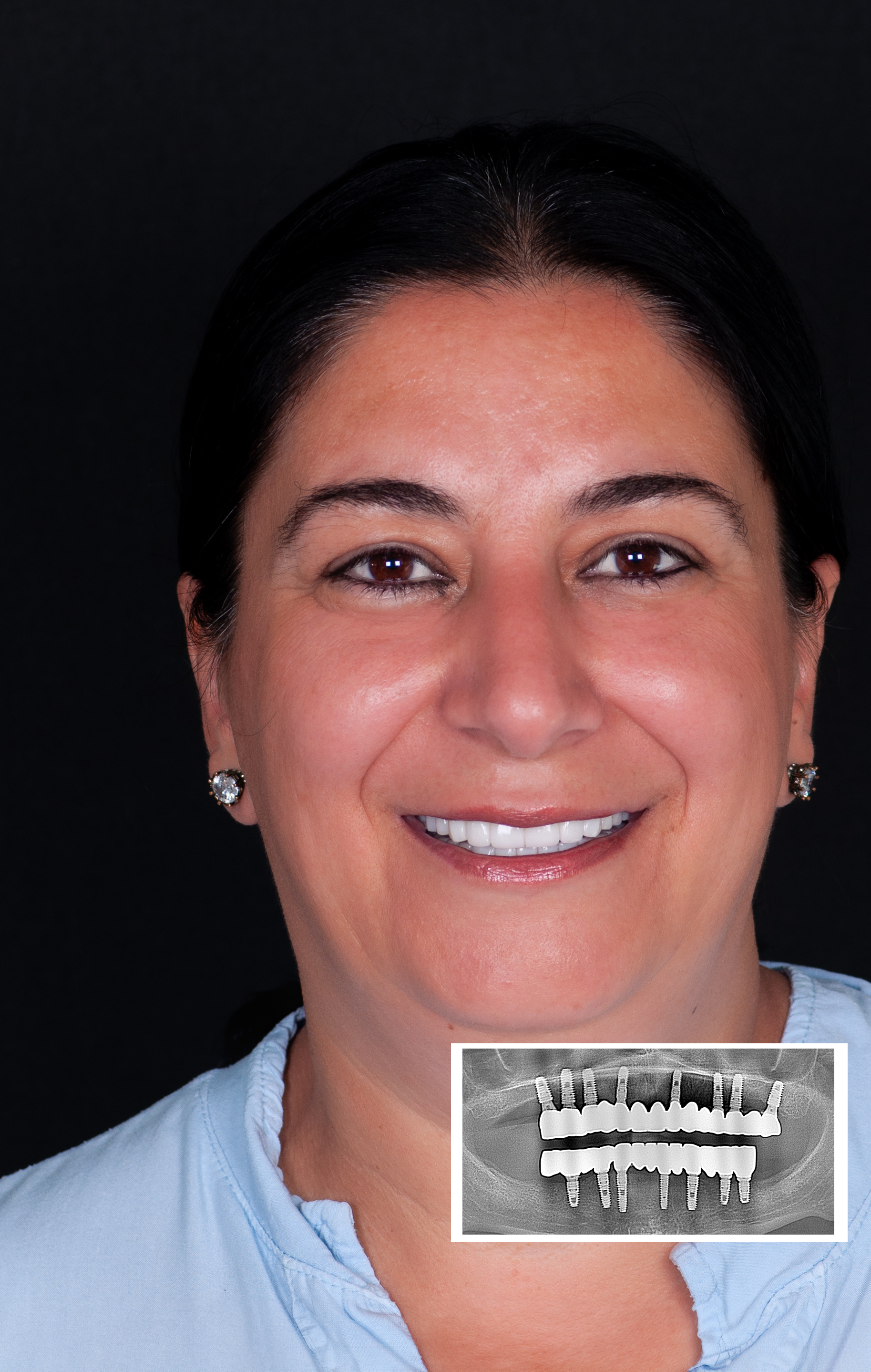 Dental Design Turkey Antalya | Best Dental Implants 3 dentaldesignturkey