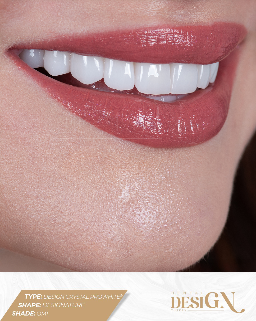Dental Design Turkey Antalya | Best Dental Implants 4 IMG 4272